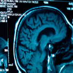 Calgary Traumatic Brain Injury Lawyers